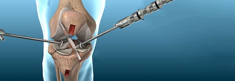 Arthroscopic Keyhole Surgery in Ahmedabad