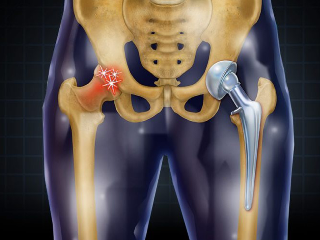 Hip Joint Replacement Surgery