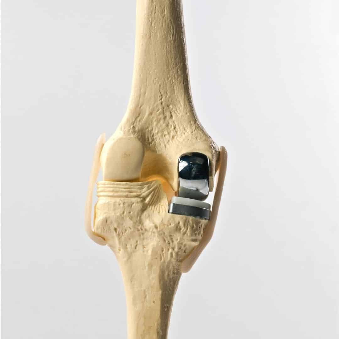 Minimally Invasive Knee Replacement Gujarat